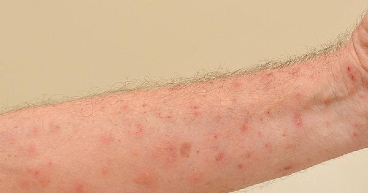 Debido a que se detectó un brote de sarna humana en la Primaria Herman Bruss, las clases se suspendieron un día extra después del “puente